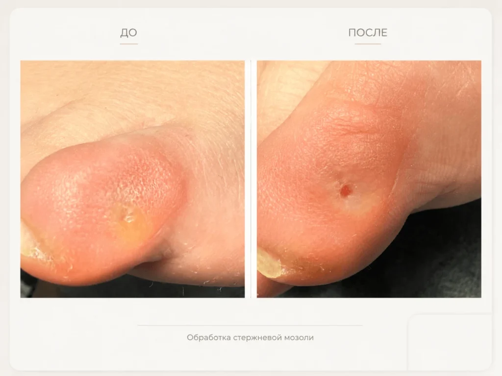 Обработка стержневой мозоли